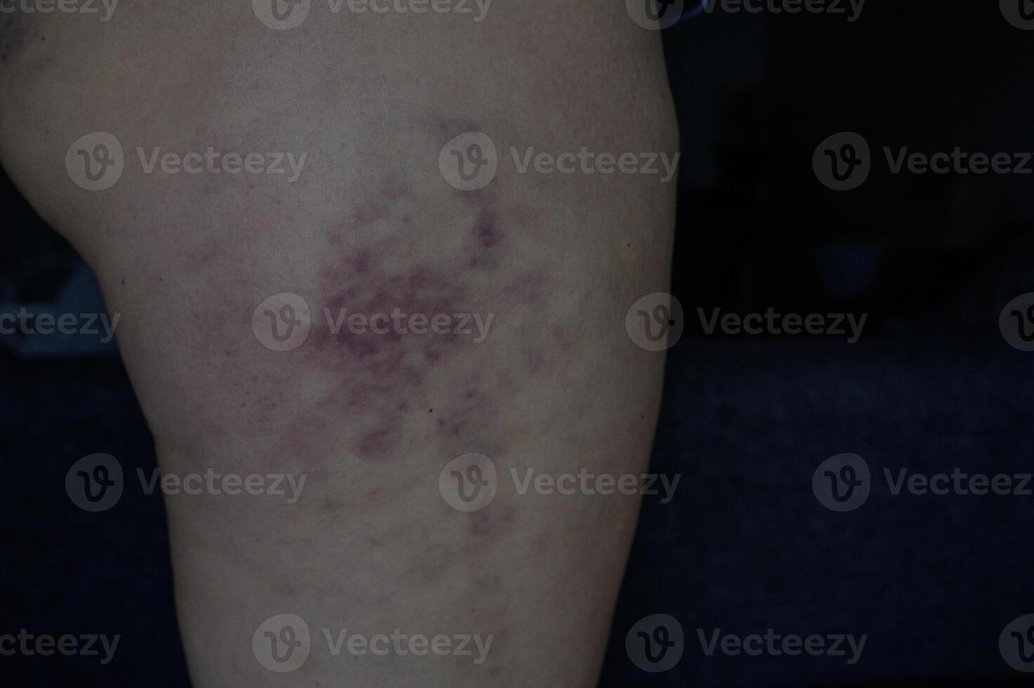 A person with a rash on their leg photo