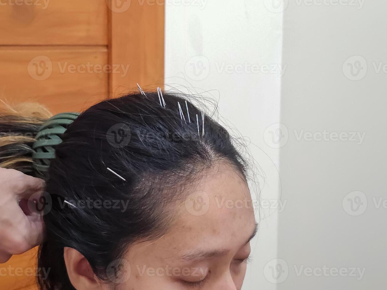 Front view Acupuncture on the head to balance the body reduce dizziness headache migraine. Restore the body that has lost its balance to return to balance. photo