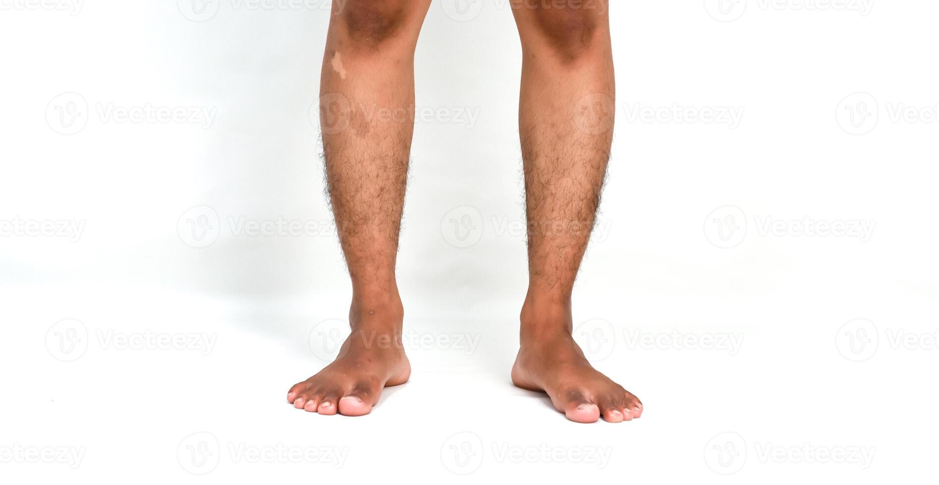 Close-up of a person's hairy legs and bare feet standing on a white surface highlighting a skin condition photo