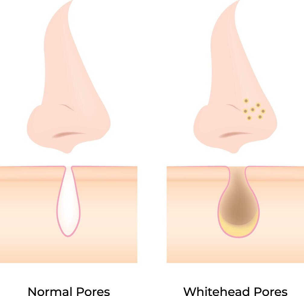 Normal Pores vs Whitehead Pores illustration vector