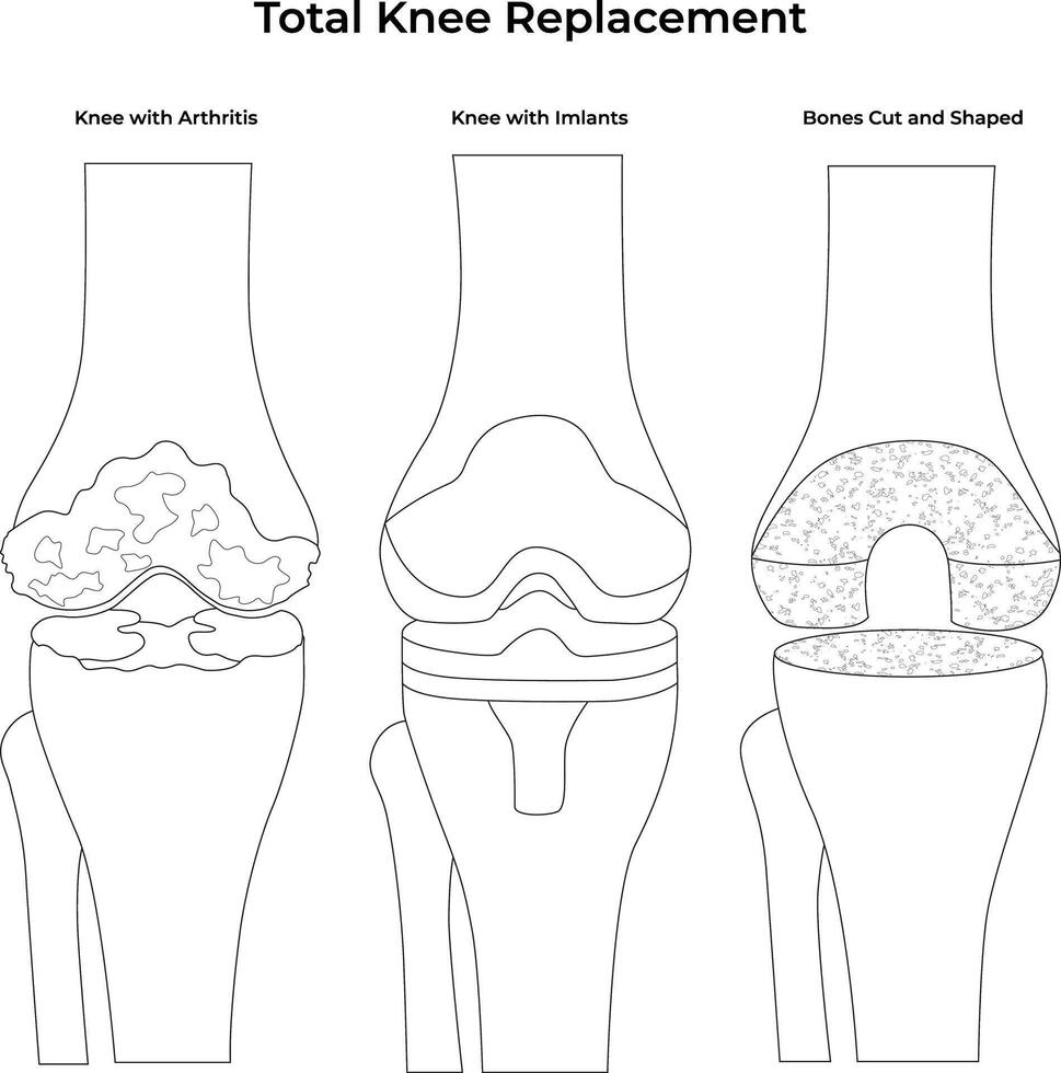 Total Knee Replacement Surgical Procedure Illustration vector