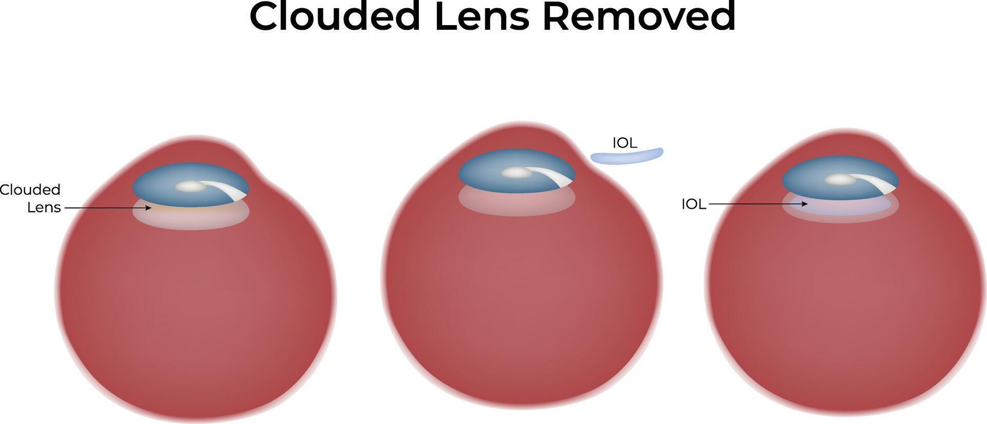 Clouded Lens Removed Science Design Illustration Diagram vector