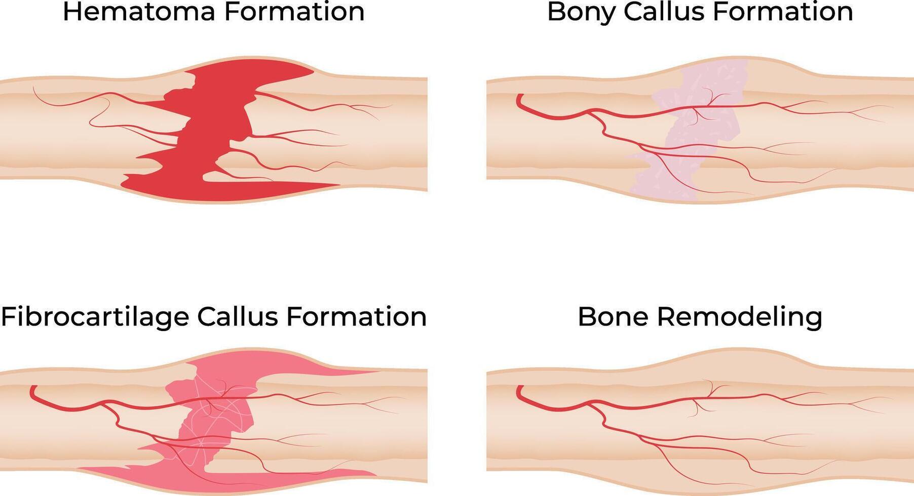 Stages of Bone Fracture Healing Hematoma Callus Formation and Remodeling vector