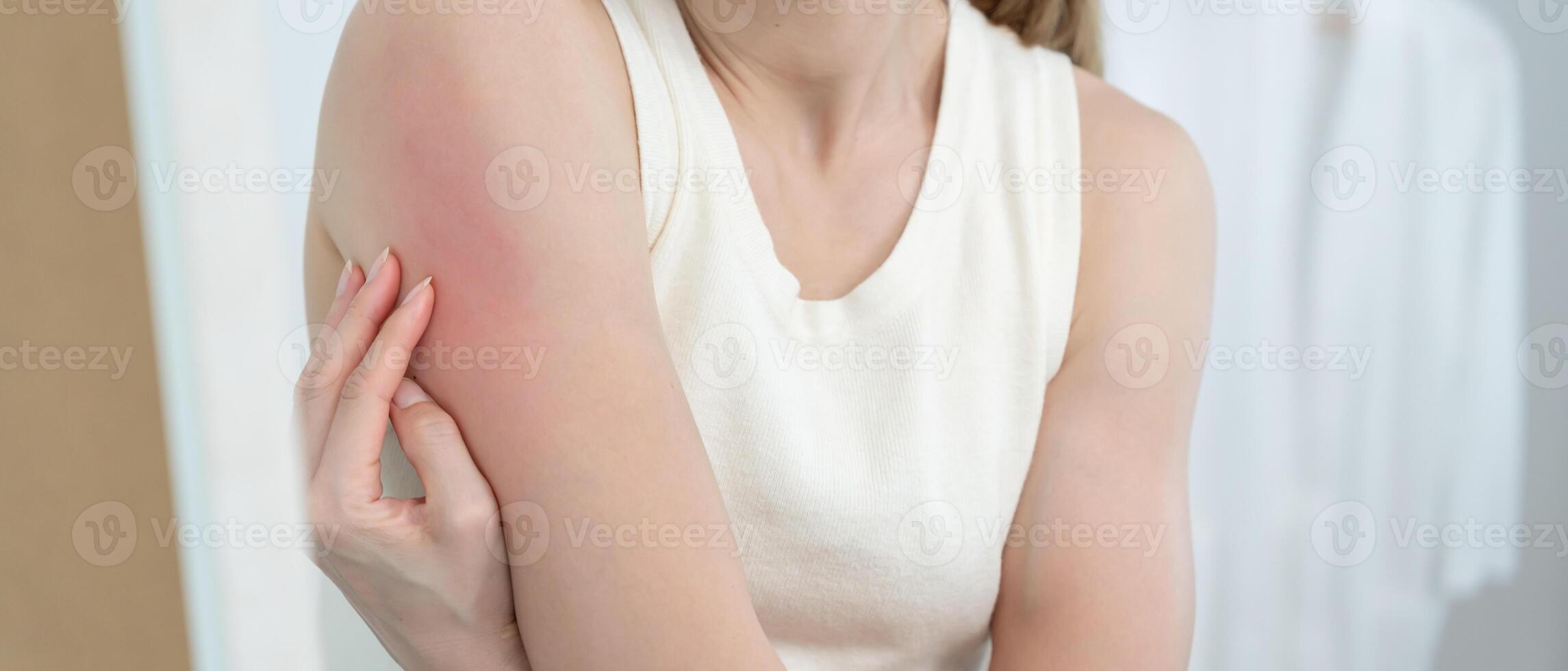skin problem and beauty. Young woman scratch body has itchy skin from skin allergic, steroid allergy, sensitive skin, red from sunburn, chemical allergy, rash. insect bites. Seborrheic Dermatitis photo