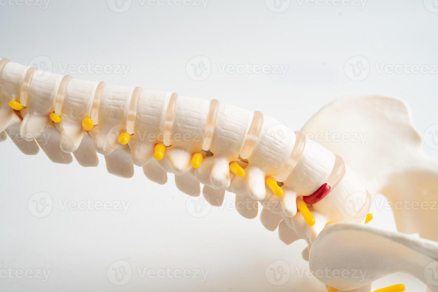 Lumbar spine displaced herniated disc fragment, spinal nerve and bone. Model for treatment orthopedic photo