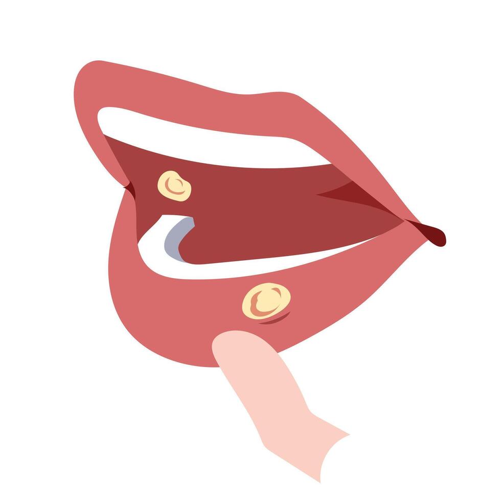 Painful mouth ulcers on human mouth illustration isolated on square white background. Simple flat colorful drawings with cartoon style. vector