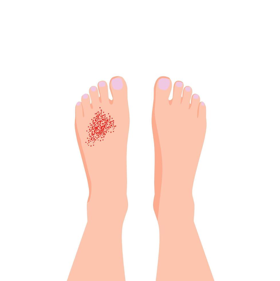 human feet showing a visible skin condition or wound on the left foot. Useful for medical, dermatology, skin disease, and health education illustrations vector