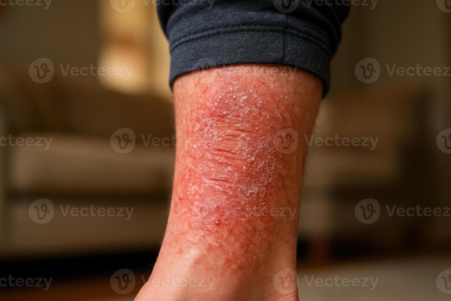 Close up of adult leg with severe dry, red, flaky skin condition, possibly eczema photo