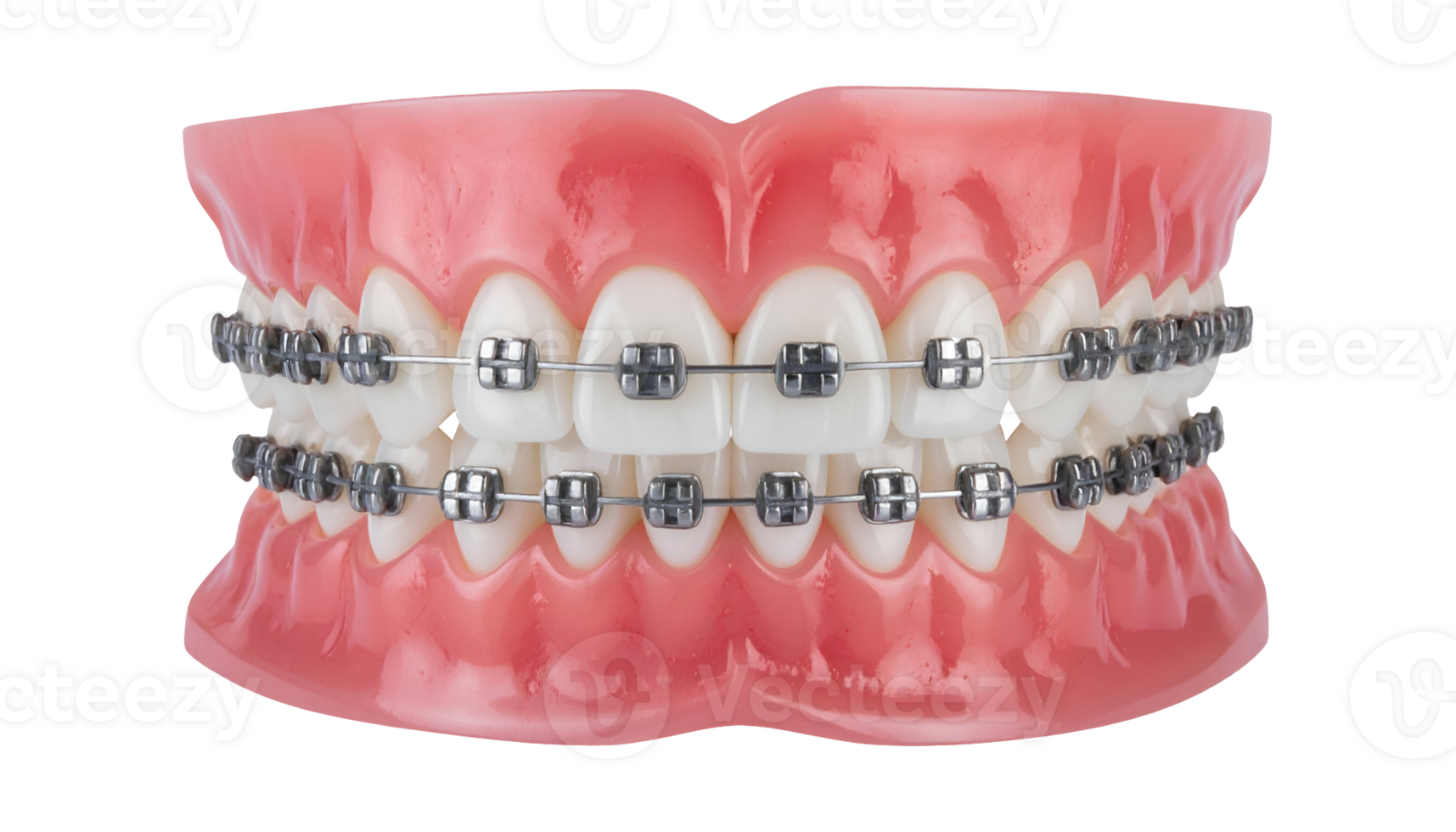 dental orthodontic model with metal braces, realistic teeth and gums anatomy for orthodontics training and dental education, full mouth bracket holder, on isolated background png