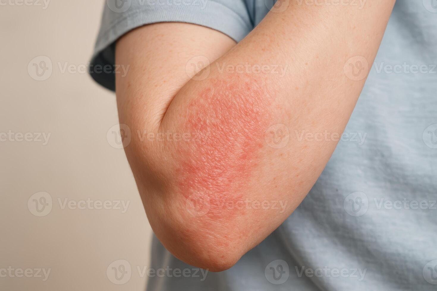 Detailed view of a human arm with a pinkish red scaly skin rash on the inner elbow photo