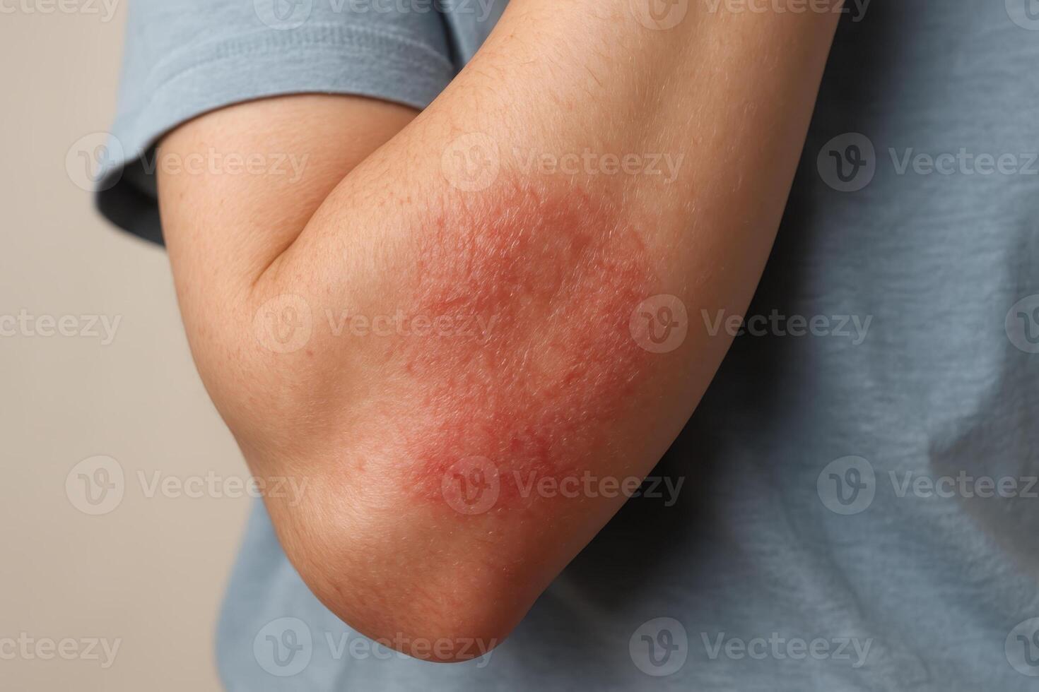 Close up of a human arm with a red, scaly skin rash on the inner elbow, showing dermatitis photo
