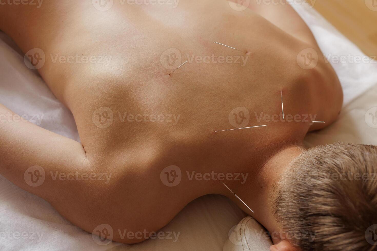 Dry Needling Therapy for Trigger Point and Muscle Pain Relief in Physiotherapy and Rehabilitation photo
