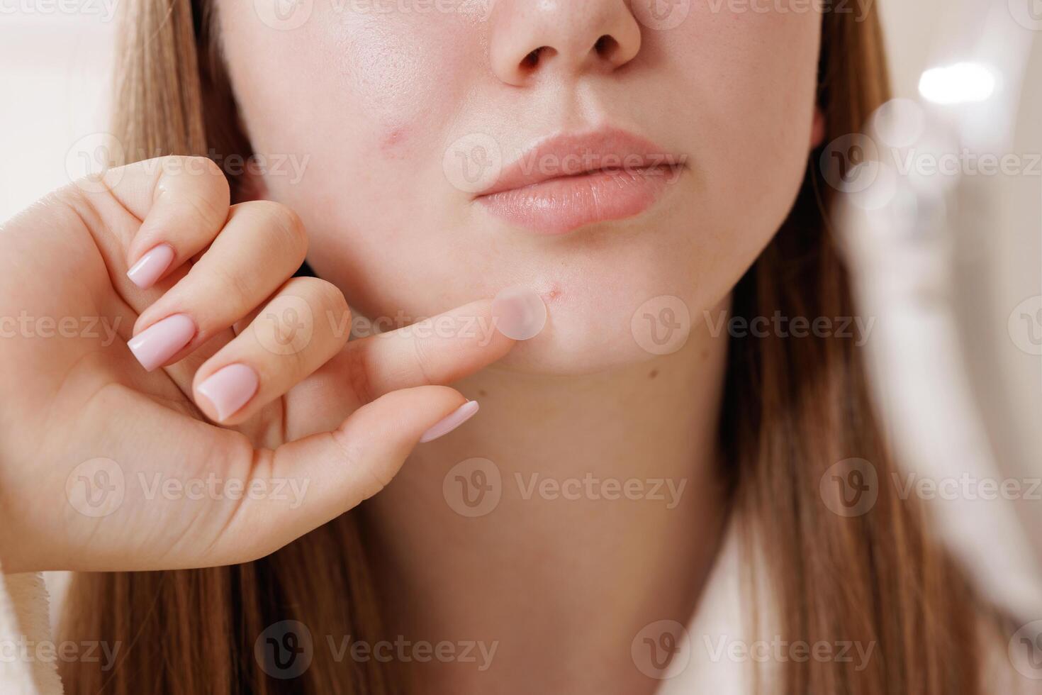 Young Woman Applying Hydrocolloid Acne Patch on Face Closeup for Pimple Treatment and Skincare photo
