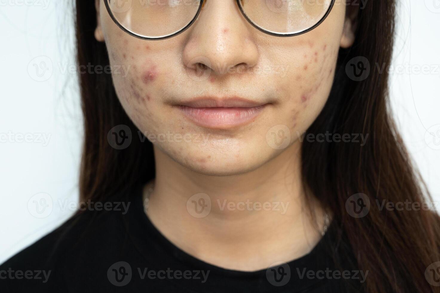 Cropped shot view of Asian woman having acne inflamed on her face. photo