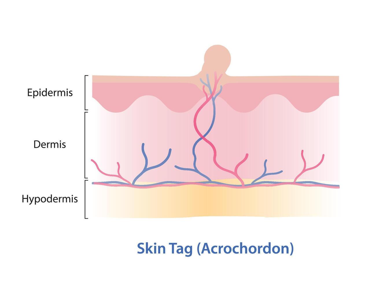Infographic of skin tag illustration. Skin tag is small excess piece of skin that protrude from surface skin, often grow on neck, armpits, eyelid, under breast, groin, thigh and genital. vector