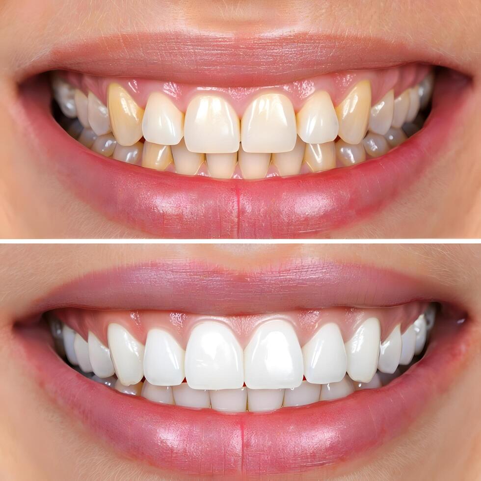Teeth Whitening Before and After Comparison Close Up Smile photo