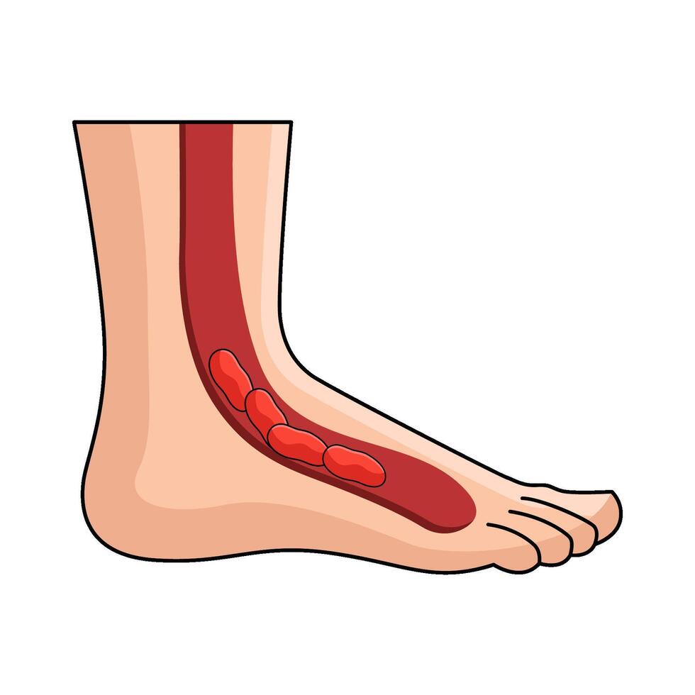 blood vessel clot of leg and diabetic foot vector
