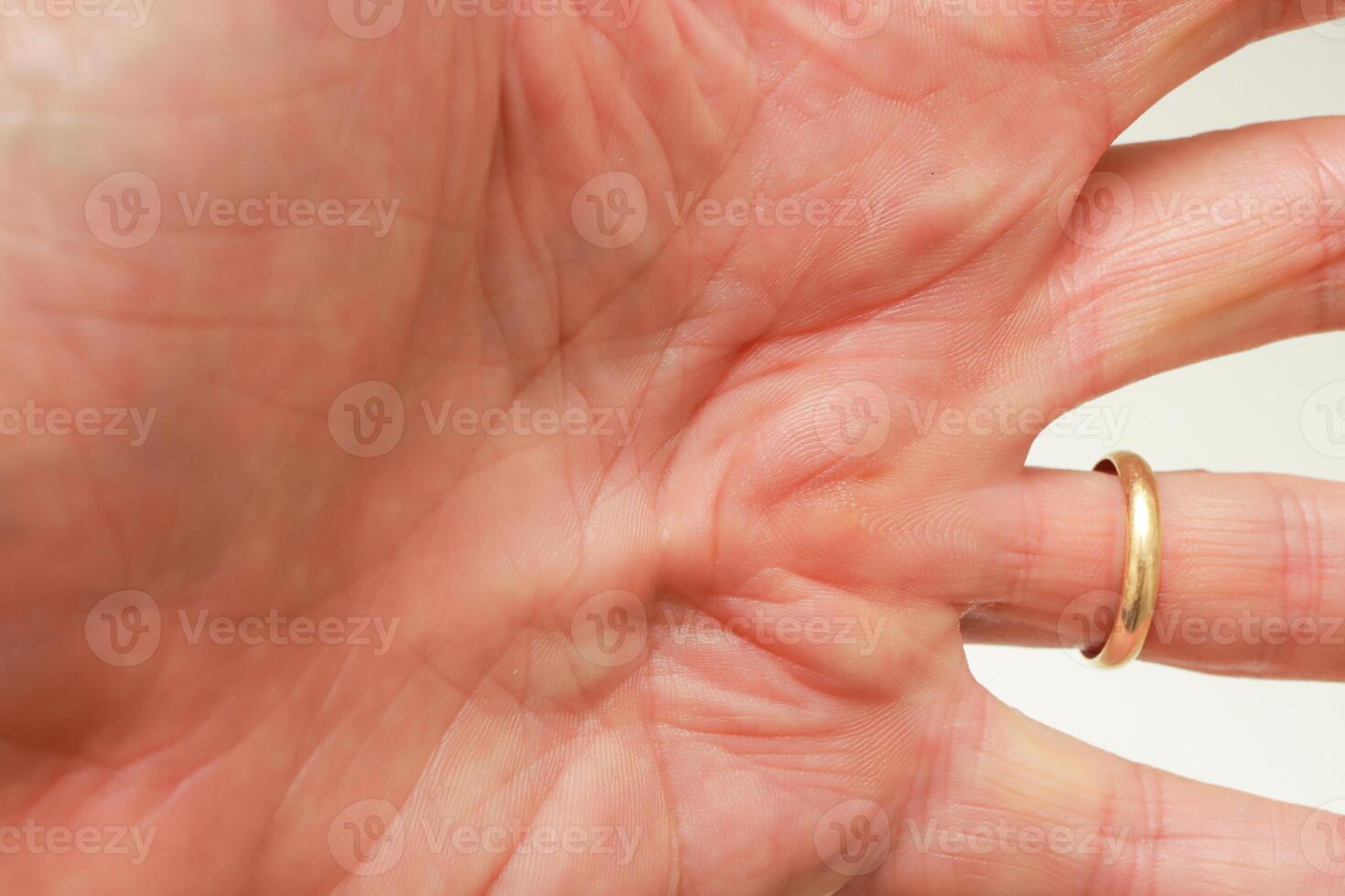 Man with Dupuytren Contracture on the palm of his hand photo