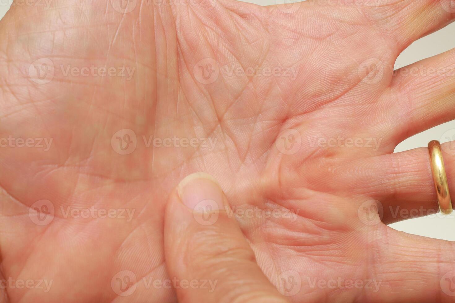 Senior Man with Dupuytren Contracture on the palm of his hand photo
