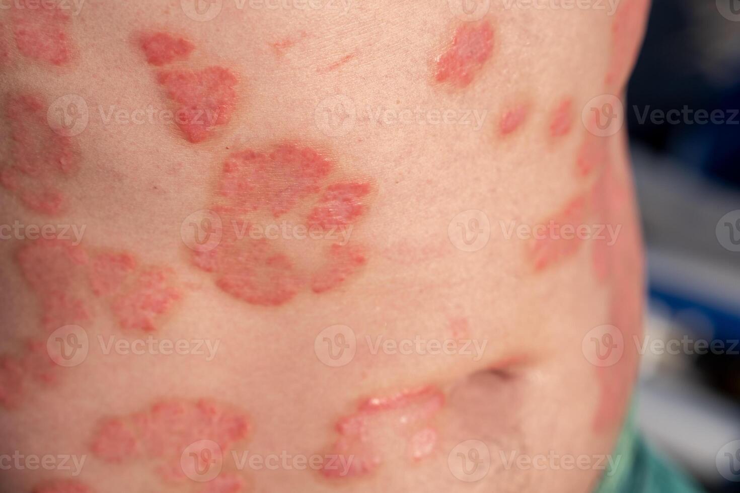 Understanding Psoriasis Through Close-Up View of Skin Lesions on a Persons Back in Clinical Setting photo