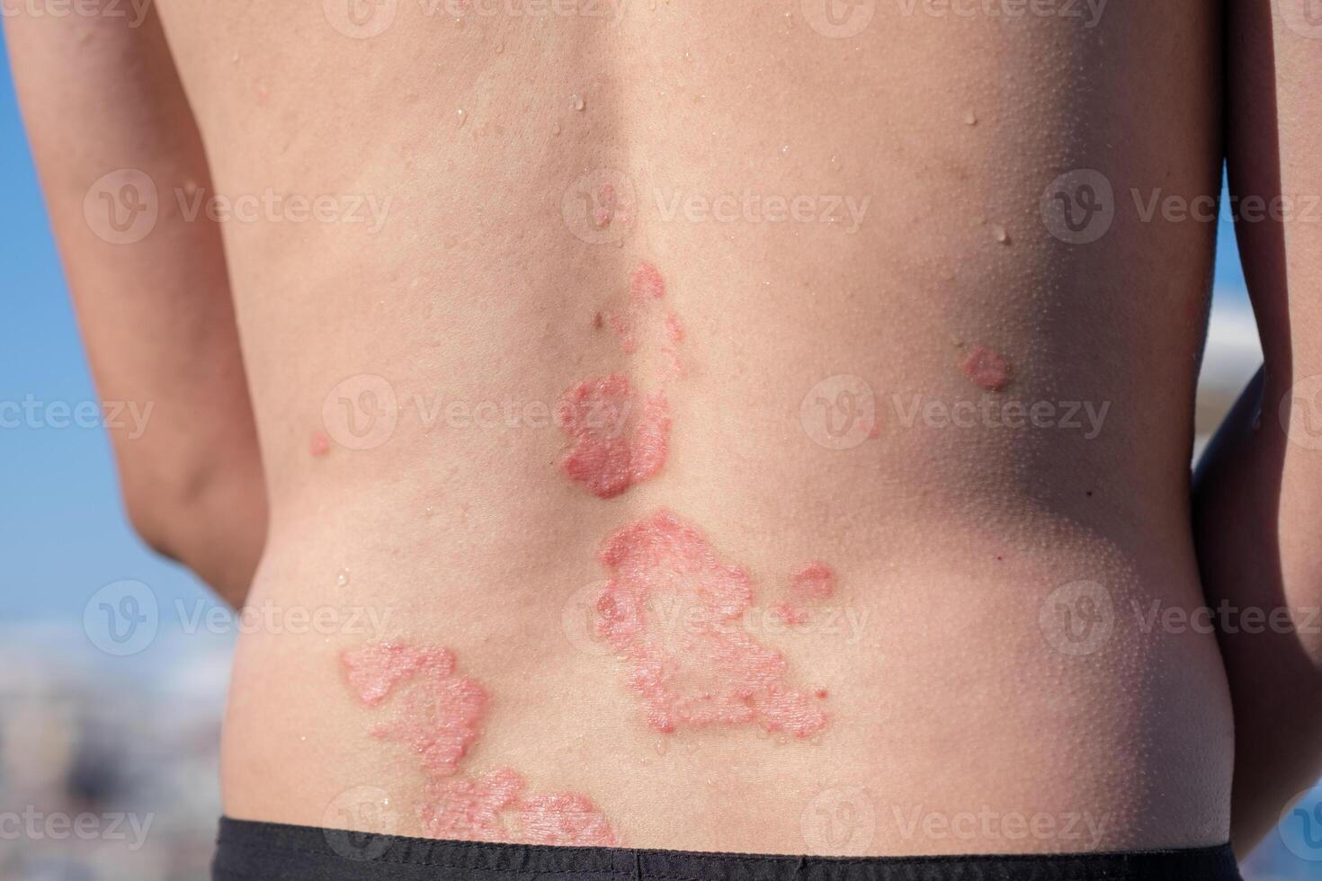 Skin Condition on Back of a Person Showing Symptoms of Psoriasis During Sunny Outdoor Day photo