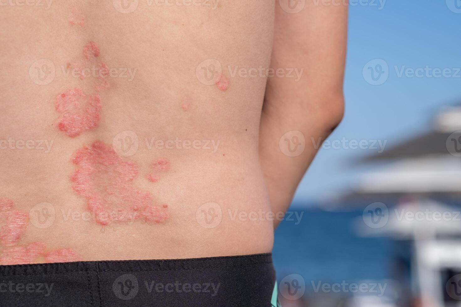 Visible Psoriasis Lesions on a Persons Back Near the Beach During Summer, Highlighting the Skin Condition in a Sunny Outdoor Setting photo