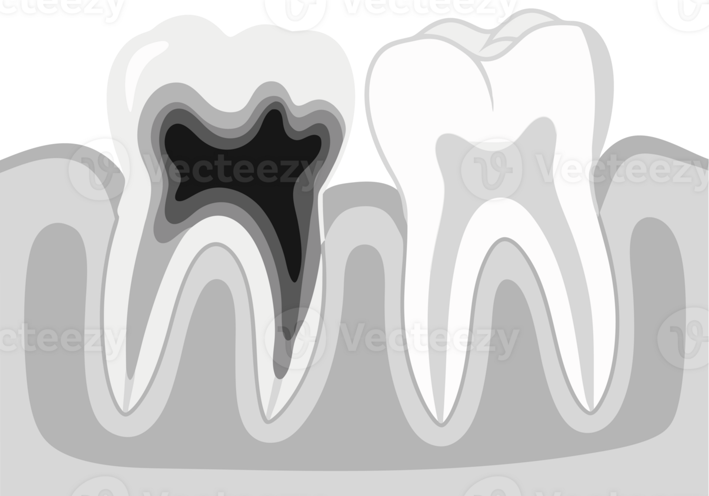 Conceptual Illustration of Dental Health Issues Featuring Decayed Tooth and Cavity as a Representation of Oral Hygiene Challenges and Associated Pain png