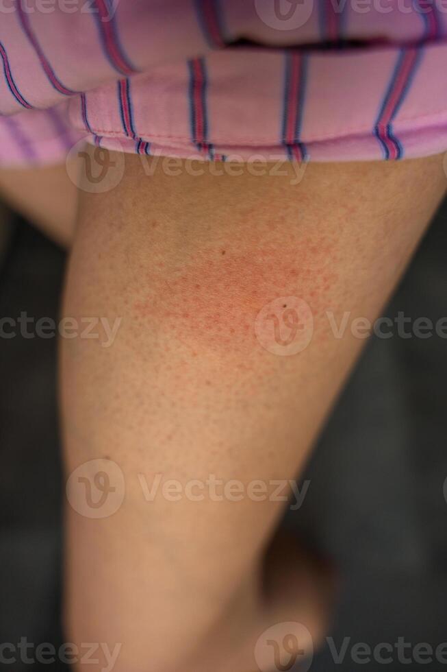 Red swollen spot on womans leg after insect sting or allergic skin reaction photo