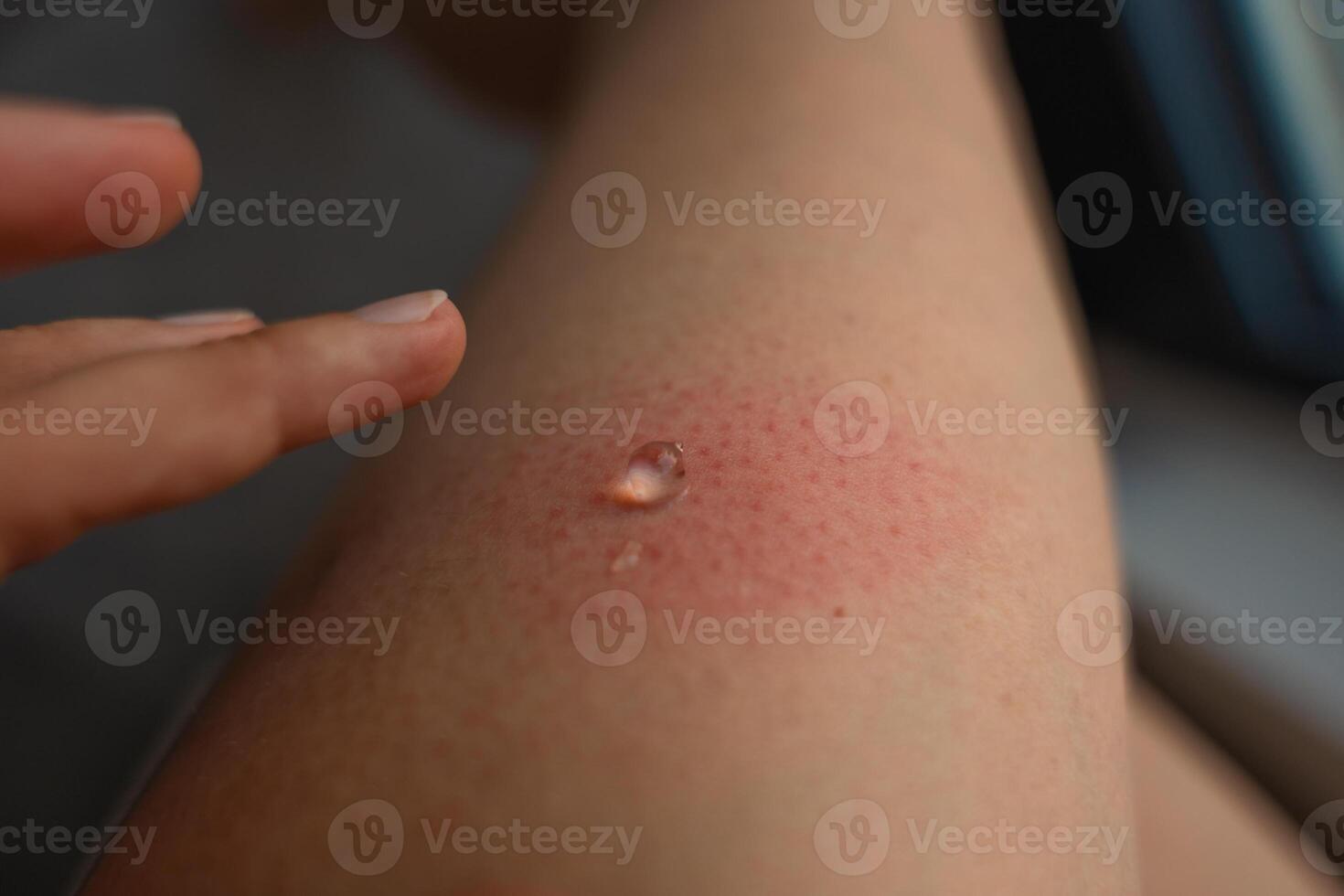 Applying gel to swollen red wasp sting on woman leg with allergic skin reaction photo