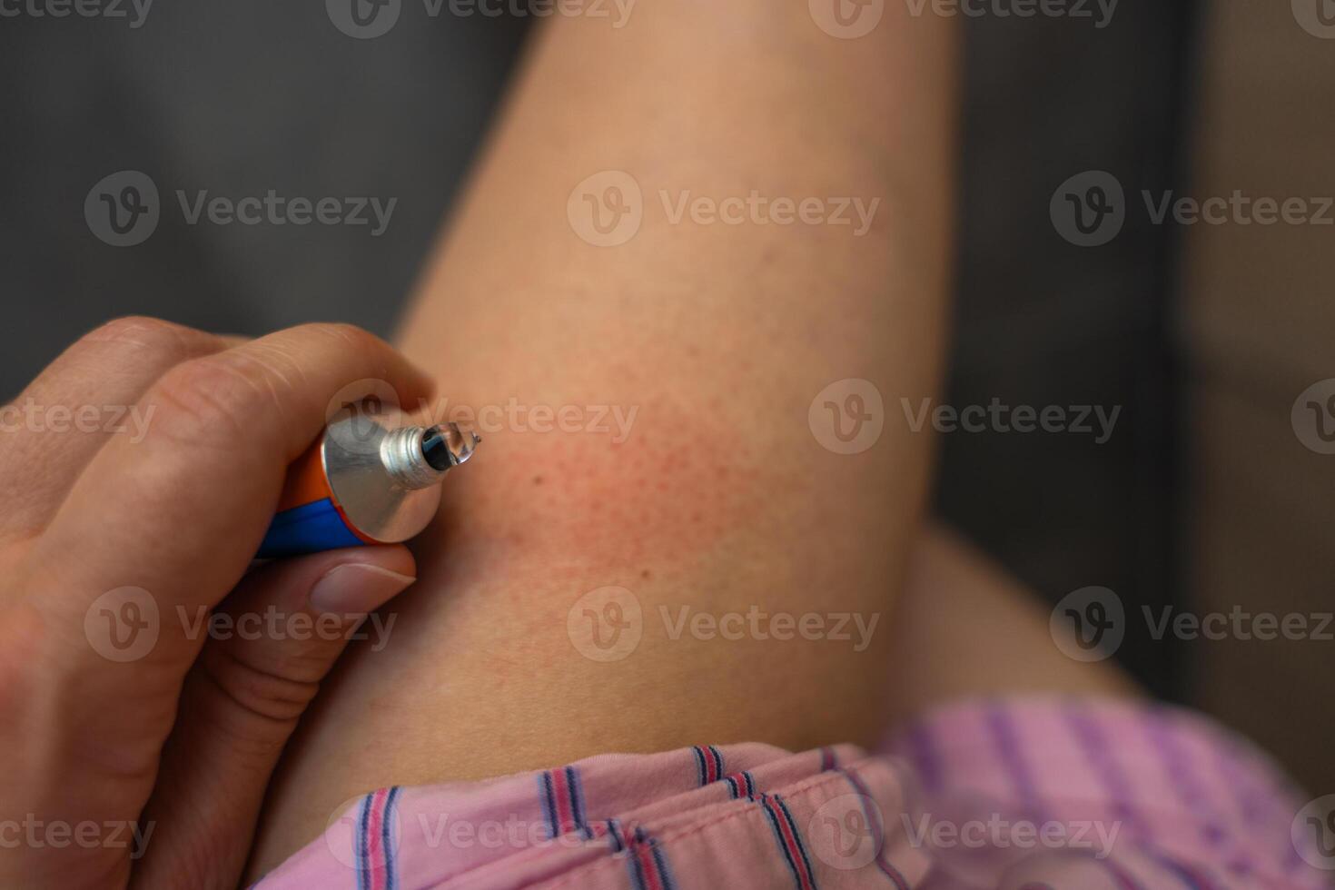Wasp sting allergy reaction on woman leg treated with antihistamine cream from tube photo
