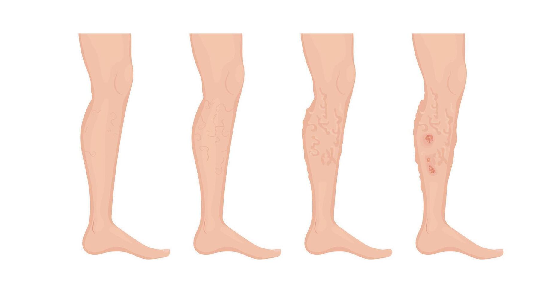 Stages of varicose veins developing on human leg, from healthy skin to thrombophlebitis vector
