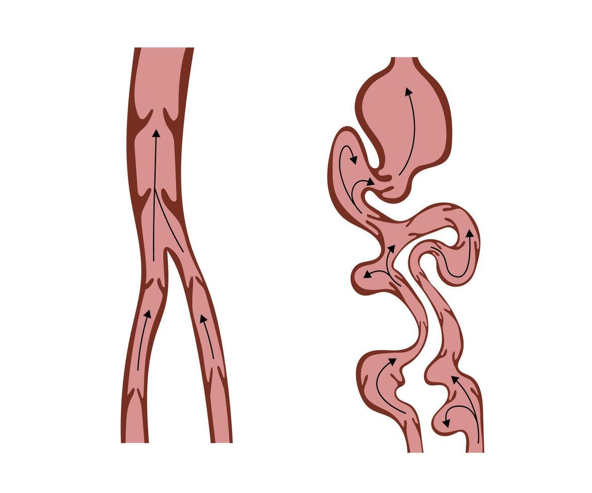 Normal Veins and Varicose Veins Showing Blood Flow vector