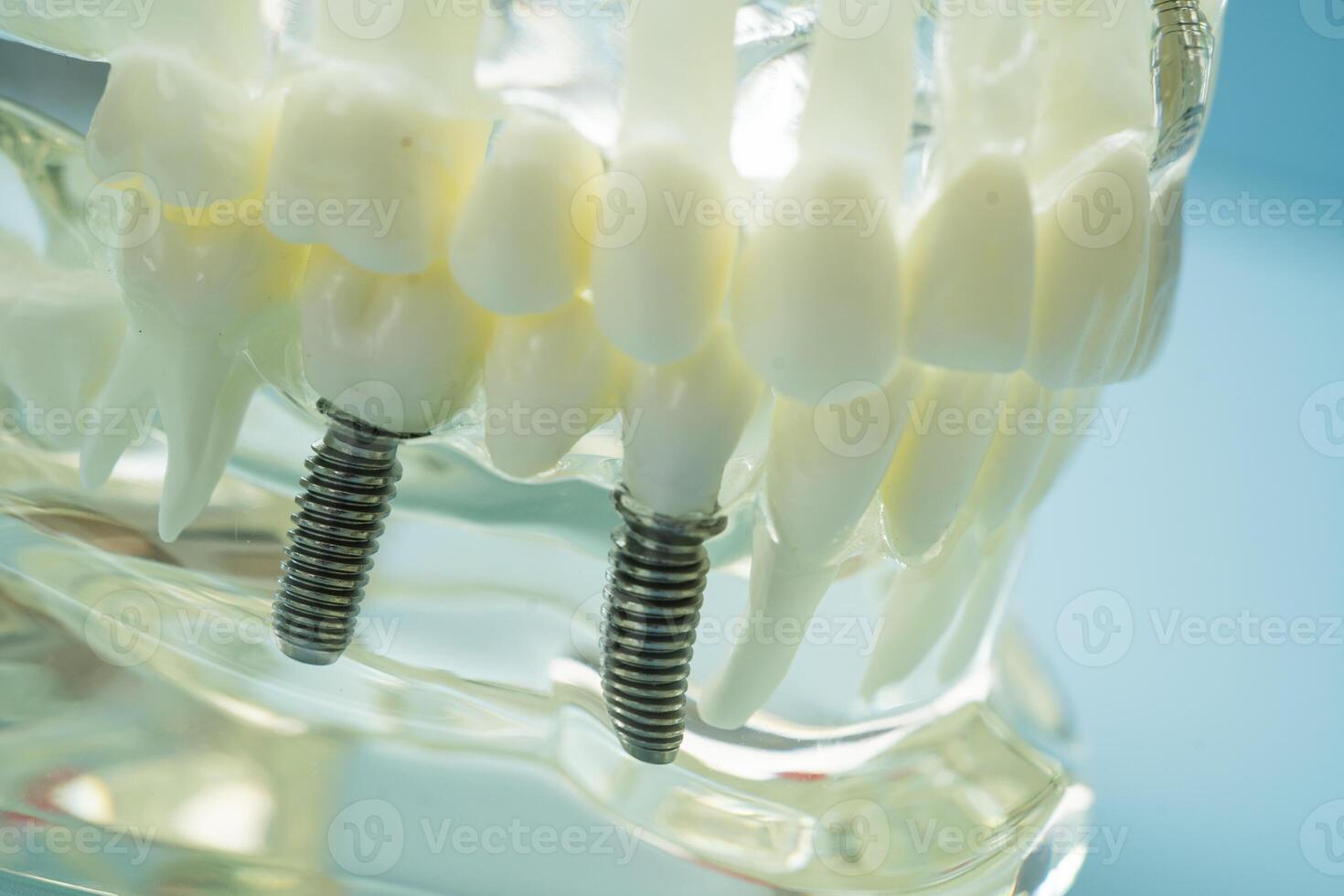 Dental implant artificial tooth roots into jaw, root canal of dental treatment, gum disease, teeth model for dentist studying dentistry. photo