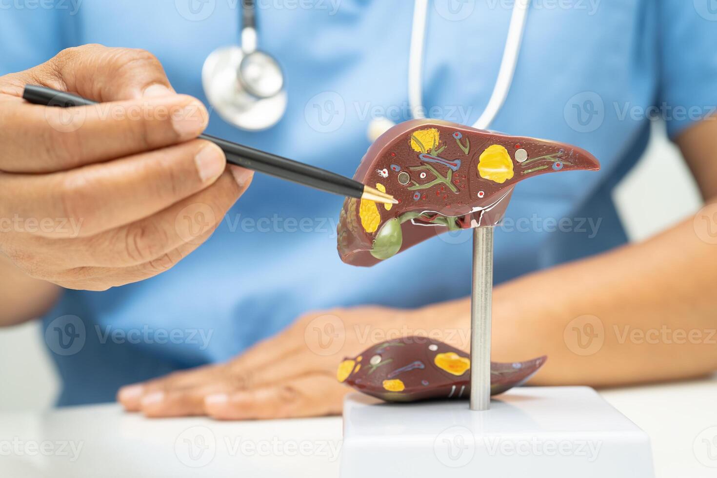 Cirrhosis Liver cancer, fatty liver, Asian doctor with liver human anatomy model in World Hepatitis photo
