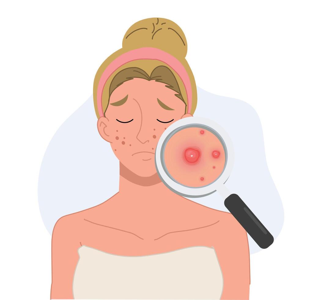Acne skin problems Concept. woman with magnifying glass is looking acne on her facial. vector