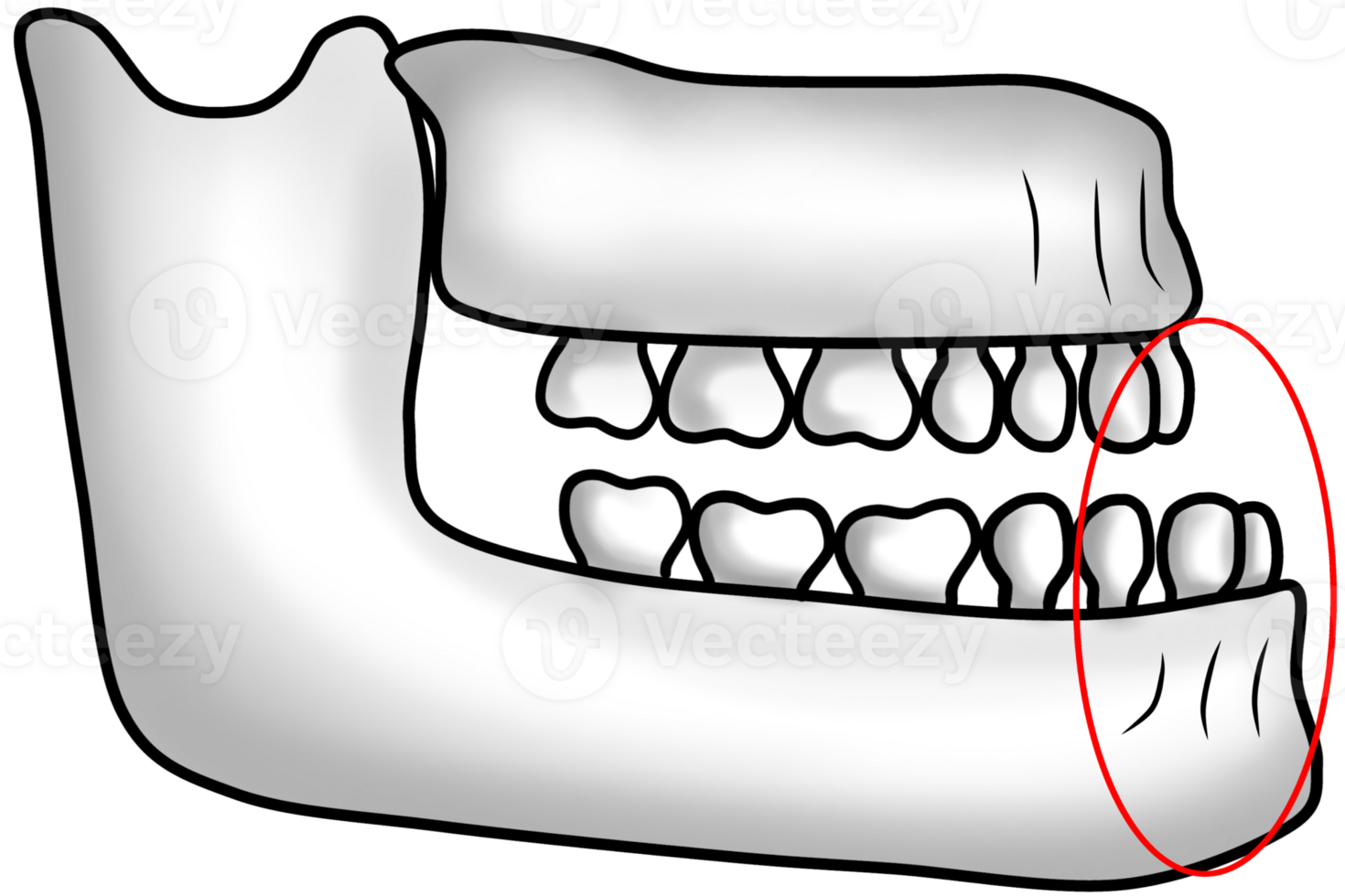 Abnormal jawbone structure with protruding lower jaw causing an underbite png