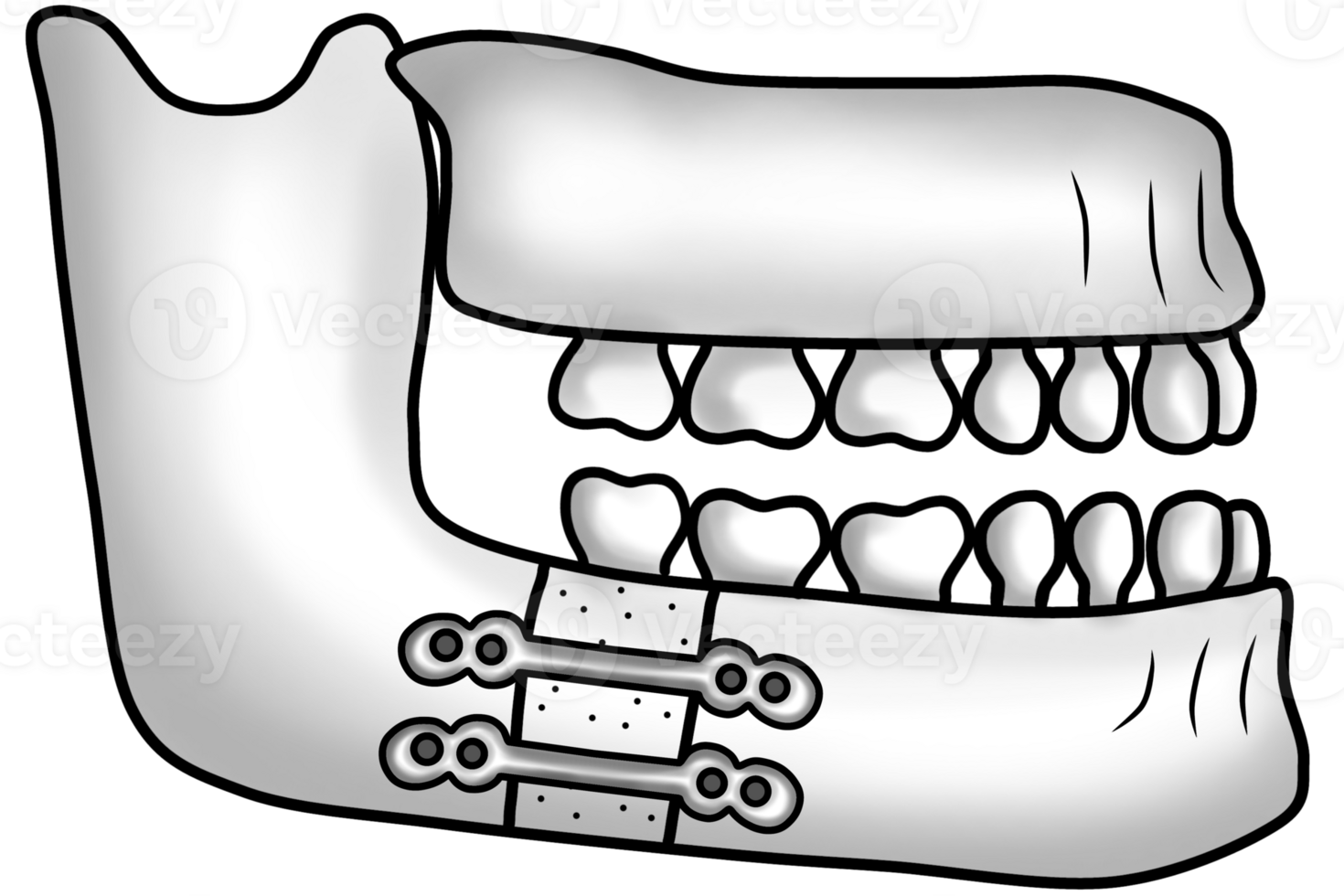 Post-surgical lower jawbone structure after correction of a protruding chin png