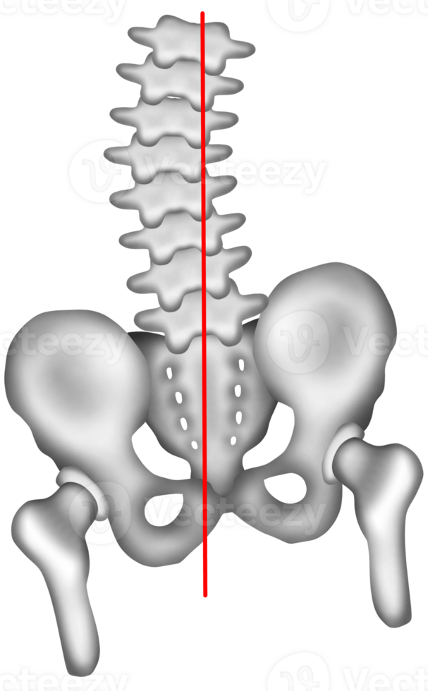 lumbar scoliosis causing uneven hip height png