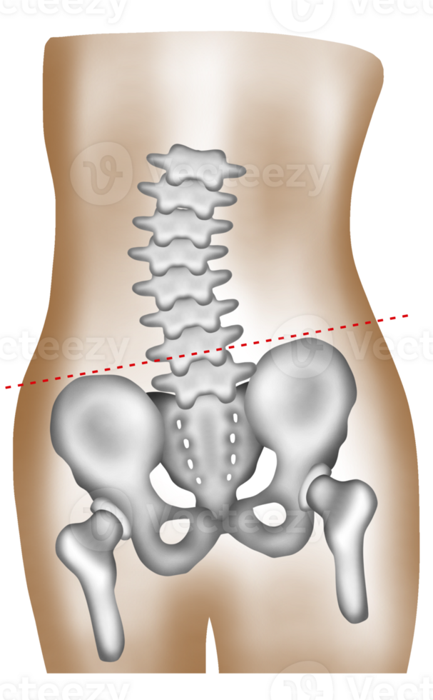 A hand-painted watercolor of lumbar scoliosis causing uneven hip height png