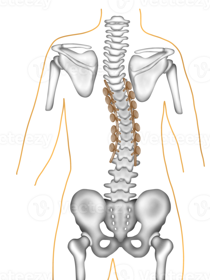 Scoliosis correction surgery using spinal instrumentation png