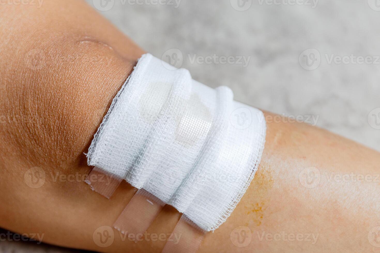 knee wound close-up. injured knee with gauze and medical tape after first aid treatment, illustrating wound care, injury recovery, and health awareness photo