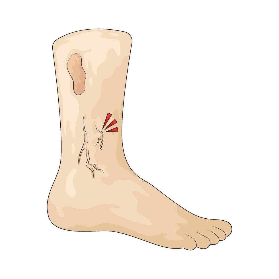 blood vessel clot of leg and diabetic foot vector