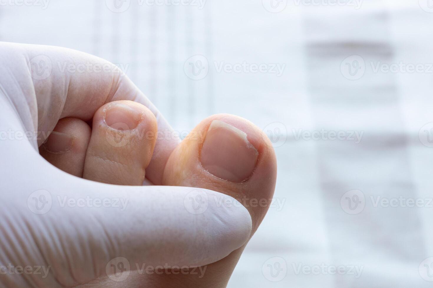 Close up of broken and injured big toe nail photo