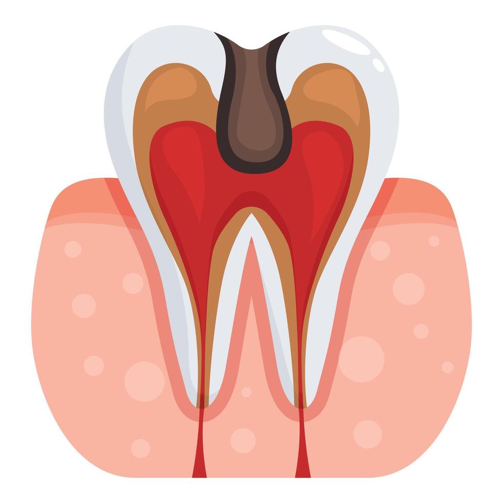 Deep tooth decay causing pulpitis and gum inflammation vector