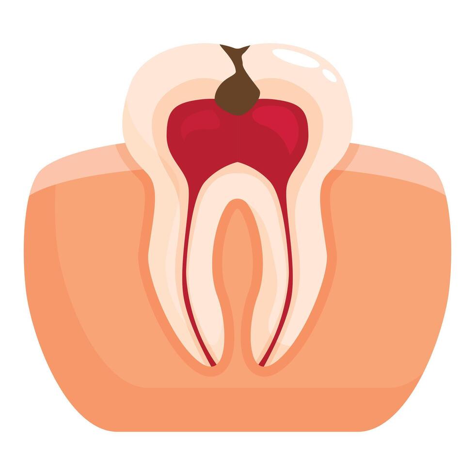 Cross section of molar showing cavity and pulp vector