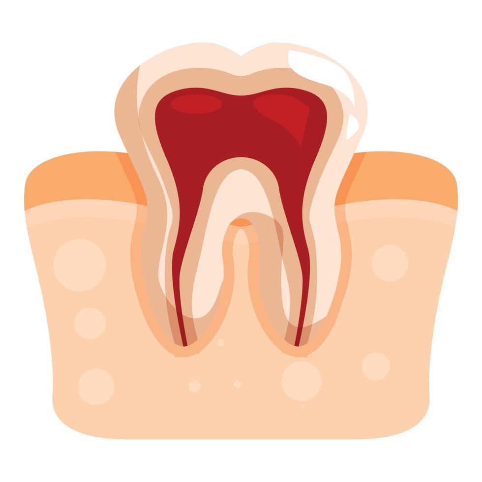 Pulpitis showing inflamed tooth pulp and root canals vector
