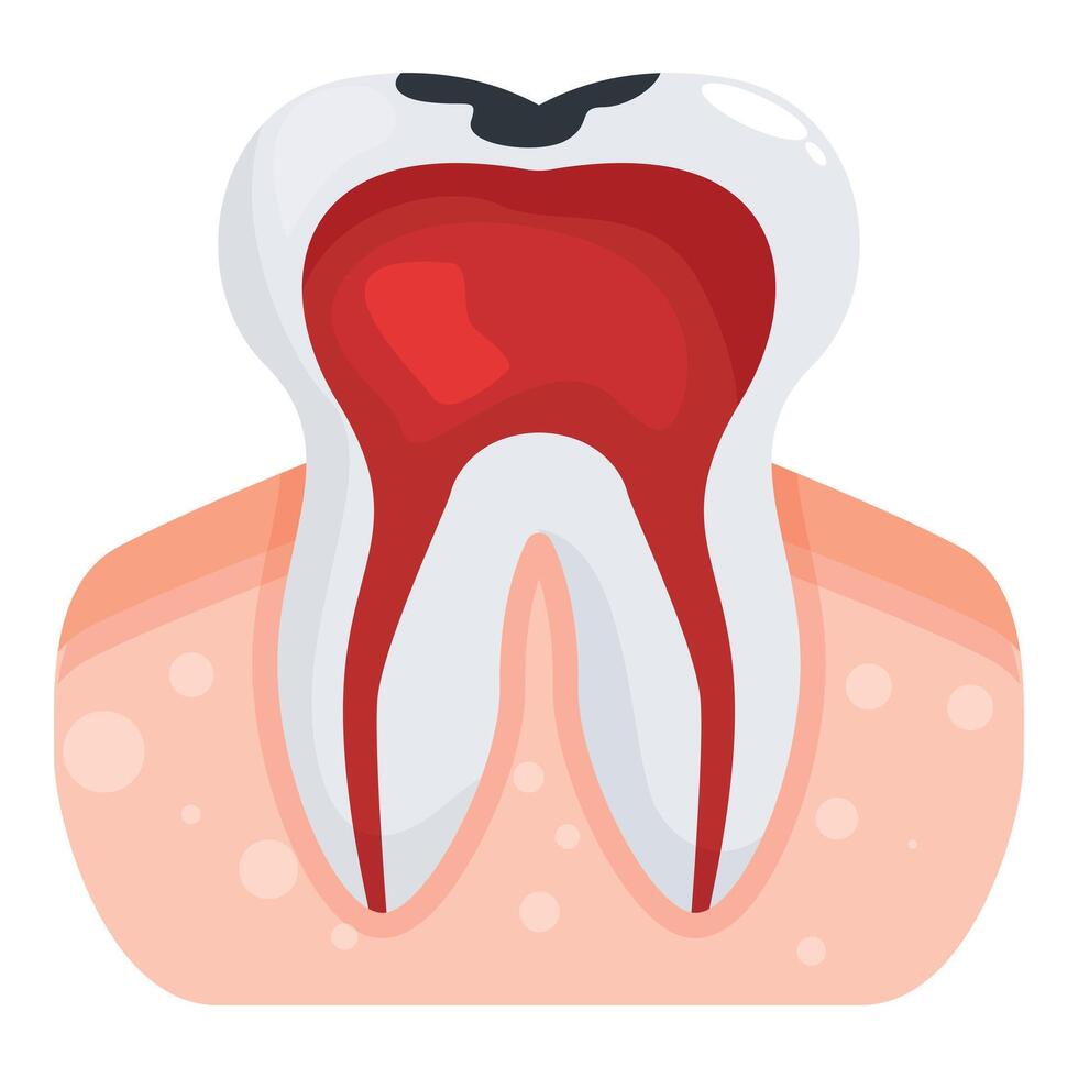 Pulpitis affecting molar tooth causing inflammation and pain vector