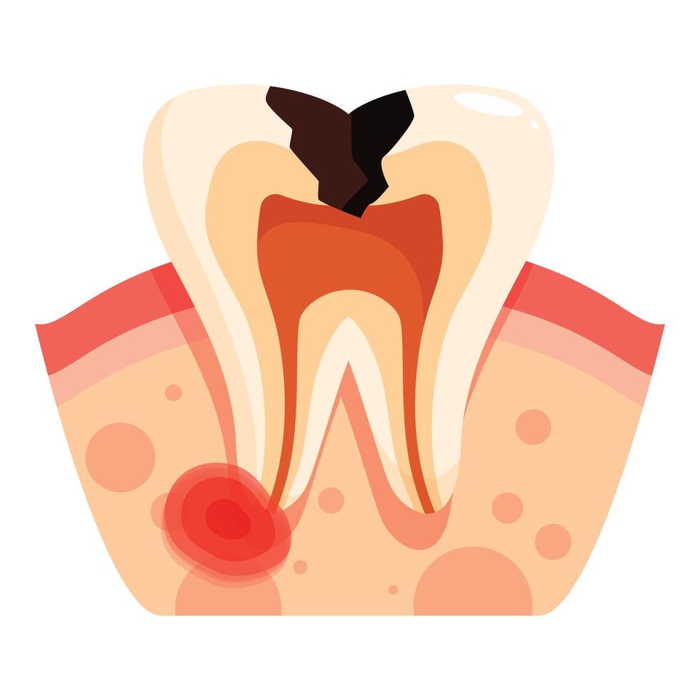 Damaged tooth showing cavity and gum inflammation vector