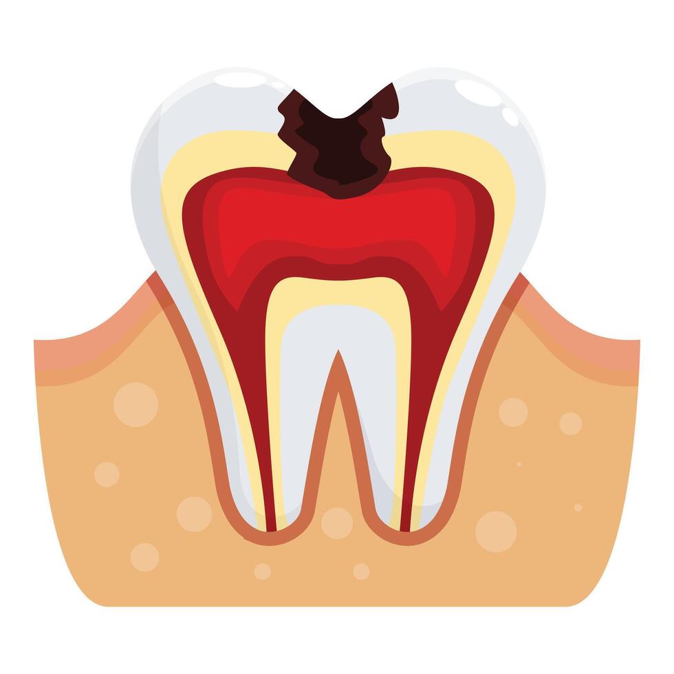 Deep tooth decay showing pulp and root canal inflamation vector