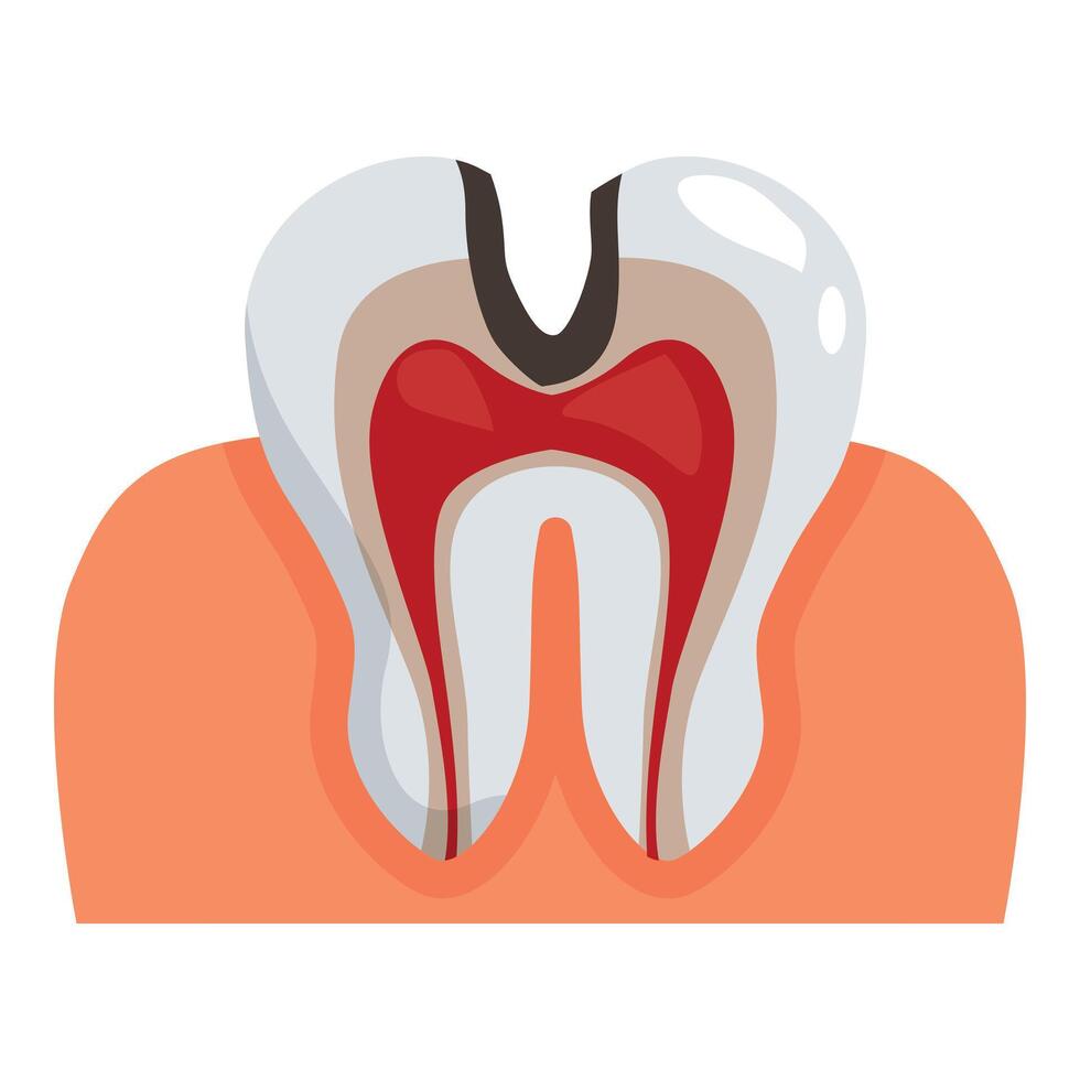 Carious tooth showing pulpitis and periodontitis with receding gums vector